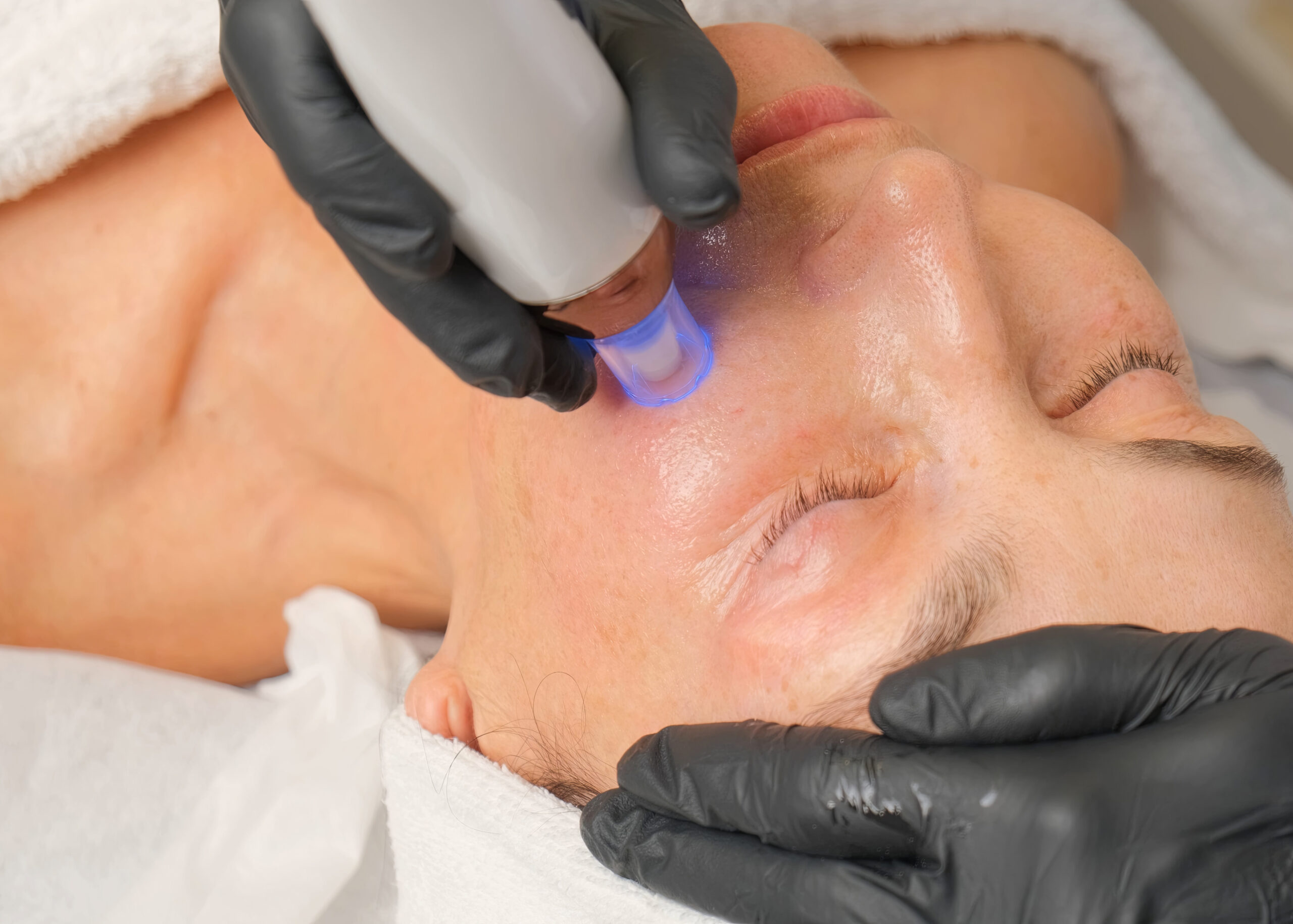 How Vivace vs Morpheus Microneedling Treatments Compare