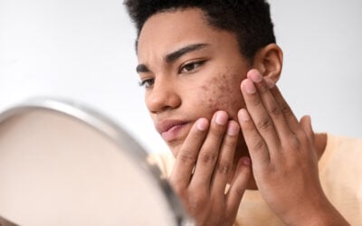Teen Acne Treatment Options in the Bay Area