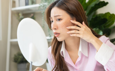 When to Worry About a Dark Spot on Your Skin (and When Not To)