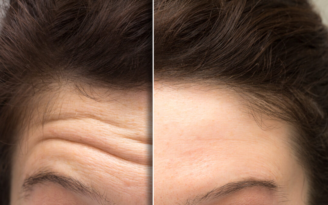 Where Botox Works Best and Where It Doesn’t