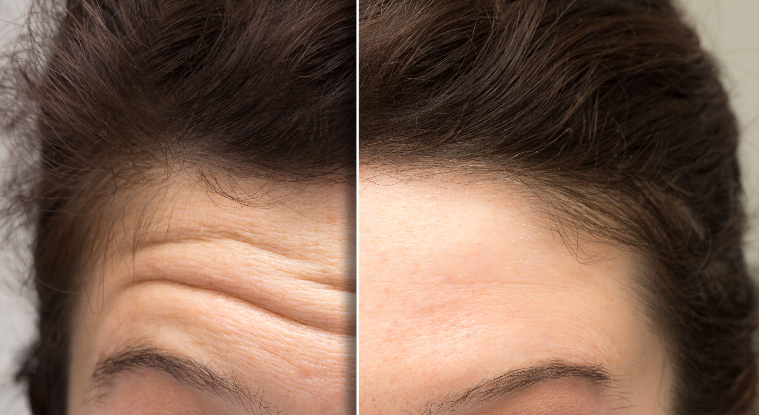 Where Botox Works Best and Where It Doesn’t