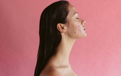 What Is the Best Treatment for Cystic Acne?