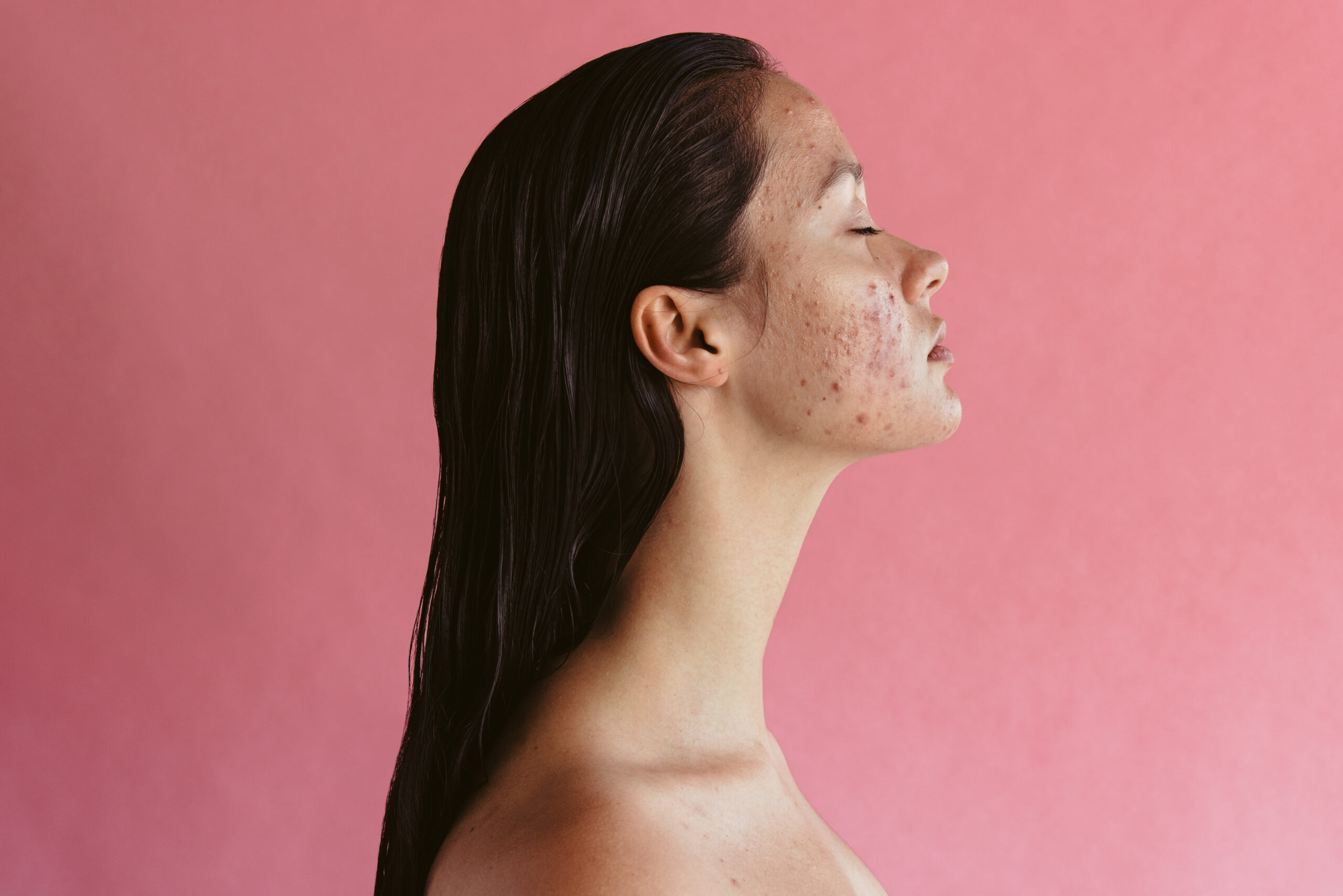 What Is the Best Treatment for Cystic Acne?