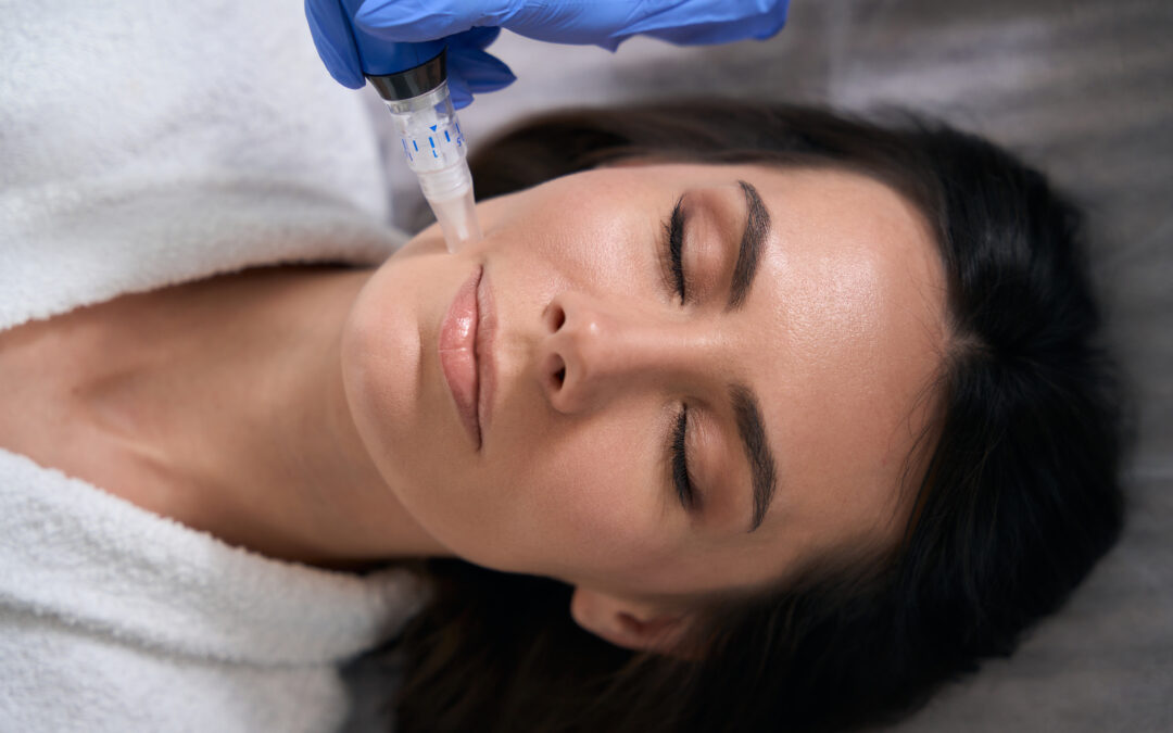 Microneedling in Berkeley | What to Know Before Treatment