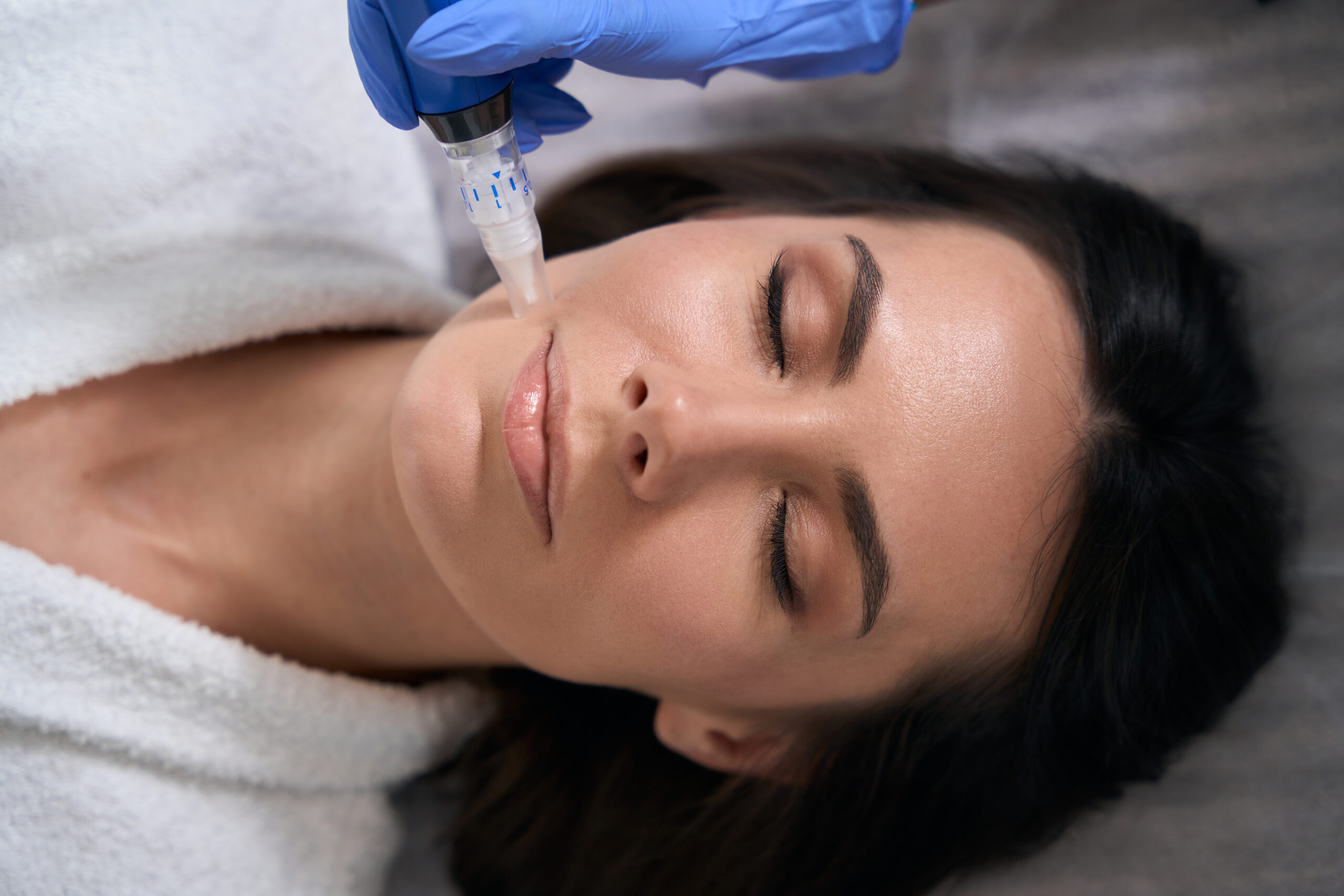 Microneedling in Berkeley Microneedling in Berkeley